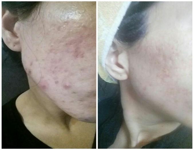 Acne.BA.jpg